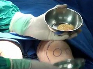 Diz Estetiğinde Super Dry Teknik - Prof.Dr. Ahmet Karacalar