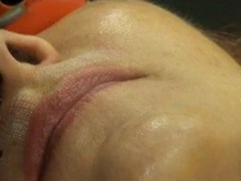 Fraksiyonel Erbium Lazer ile Dudak Üstü Gençleştirme - Prof.Dr. Ahmet Karacalar