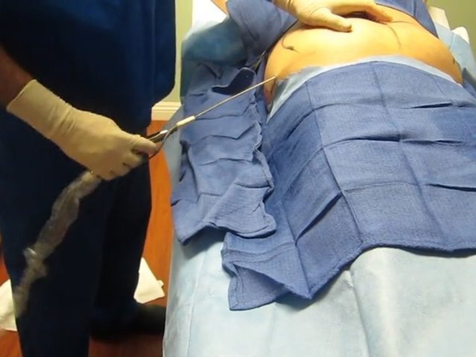 Laser Liposuction Of Abdomen and Flanks-Valley Aesthetics and Laser-626-961-7700-Pankaj Karan,M.D.