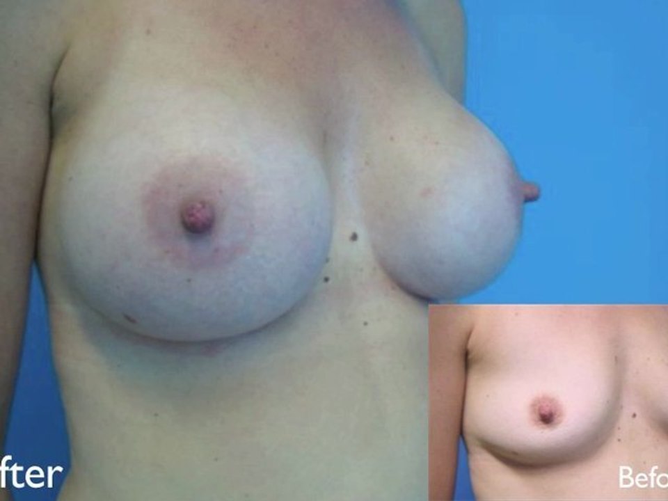 Testimonial 6 weeks Post Breast Augmentation surgery