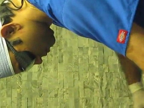 Laser Liposuction With SmartLipo MPX-Valley Aesthetics and Laser-626-961-7700