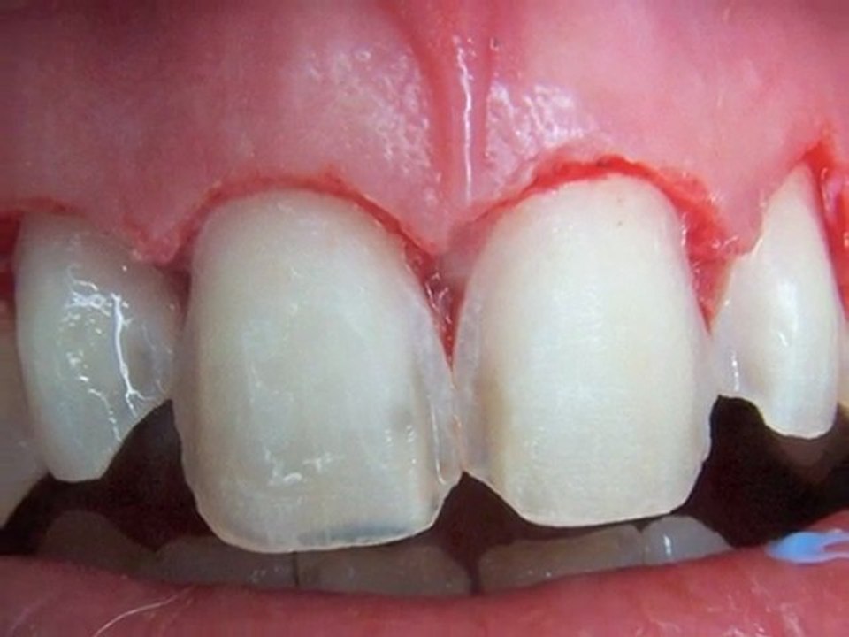 Amélioration d'un sourire gingival