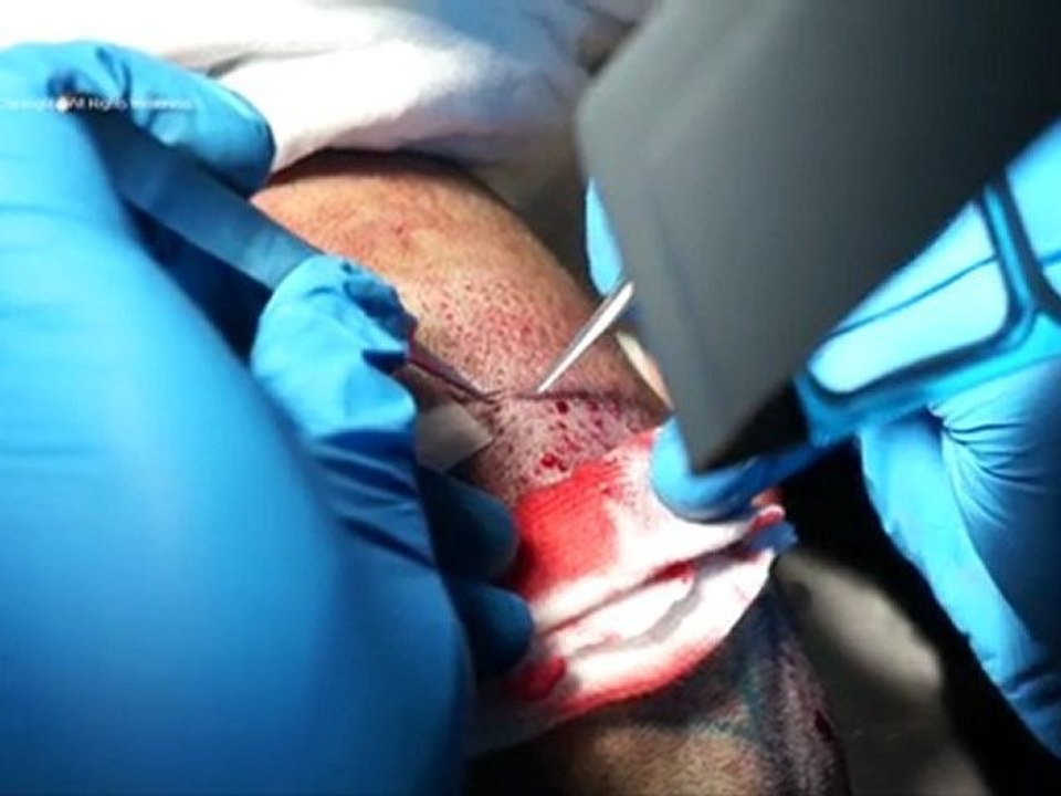Operation_FUE_FR