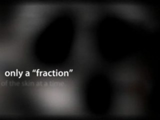 What Treatment is Best for your Acne Scars