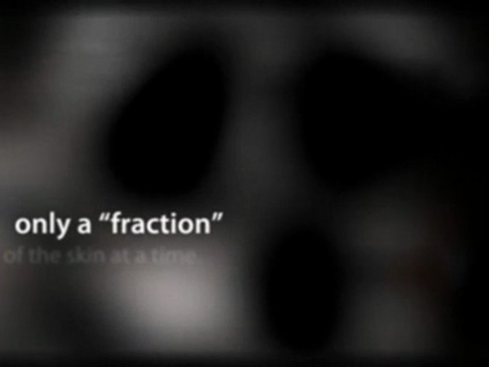 What Treatment is Best for your Acne Scars