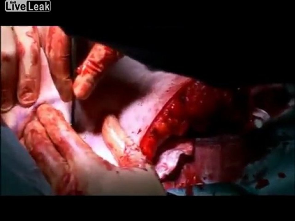 Anthony hat Brustverkleinerung GRAPHIC Man Boobs.