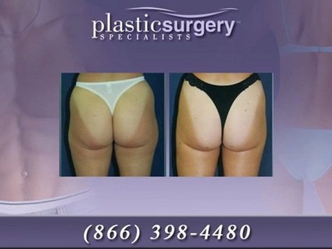 San Francisco Lipo & Body Sculpting