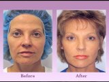 Austin Non Surgical Face Lift – How Does the Thread Lift Procedure Work?