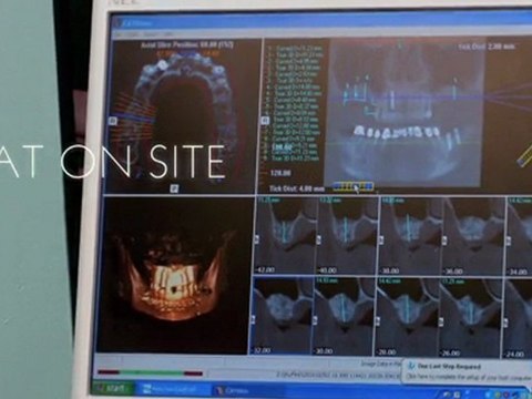 Dental Implants in Sun City - Know What The Patients Say