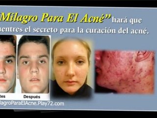 como curar el acne - acne en la espalda