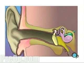 Myringotomy Insertion of Tube  - Alternatives