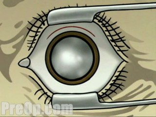 Small Incision Cataract  - Alternatives