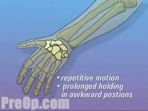 Carpal Tunnel Syndrome Repair Surgery - Alternatives