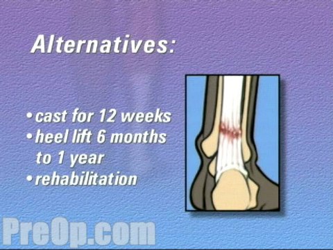 Achilles Tendon Repair Surgery - Alternatives