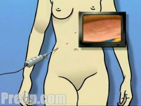 Hernia Hiatal Laparoscopic - Alternatives