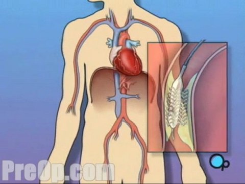 Stent Implantation Coronary Angioplasty - Alternatives
