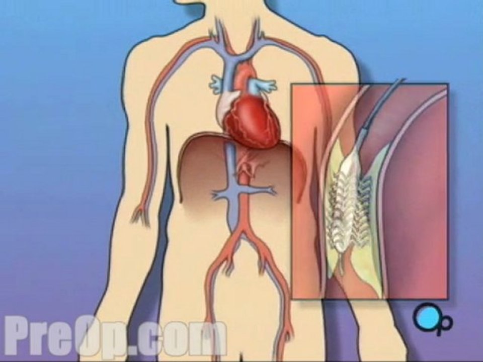 Stent Implantation Coronary Angioplasty  - Alternatives
