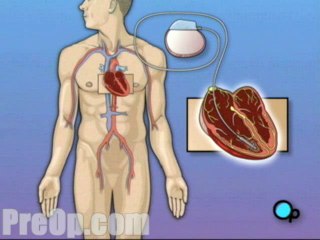 Permanent Pacemaker Implant  - Alternatives