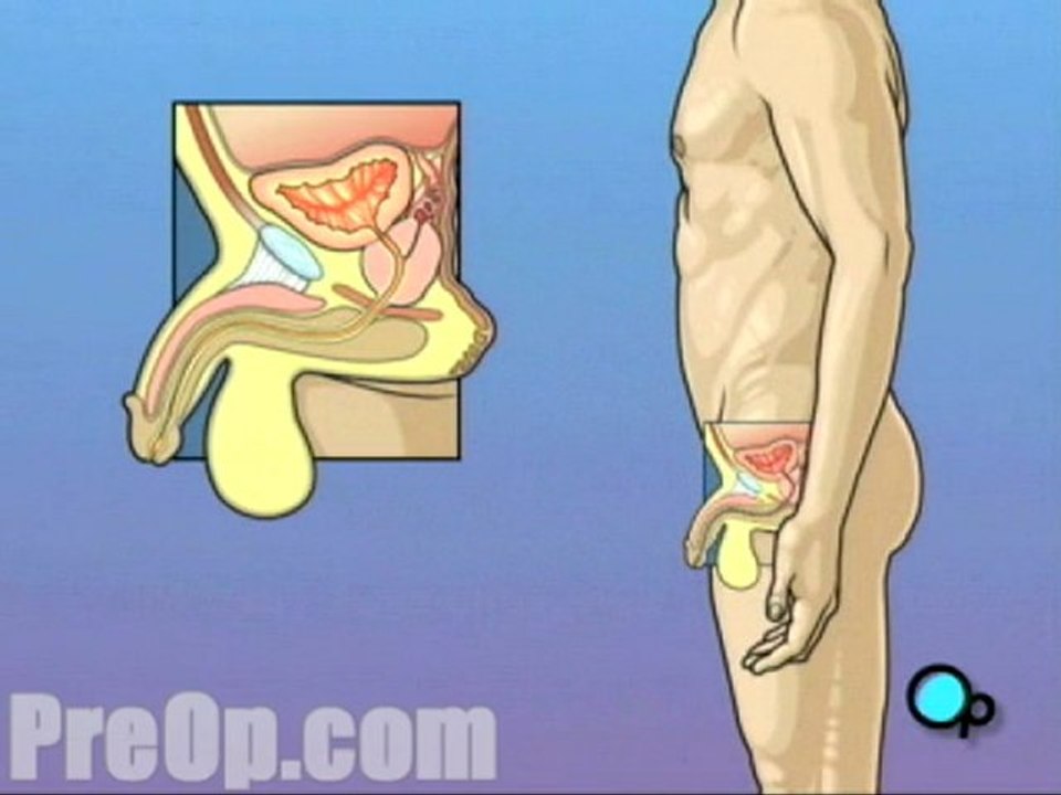 Cystoscopy Male  - Alternatives