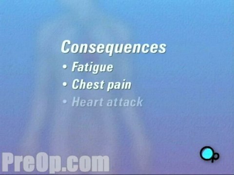 Coronary Artery Bypass Graft (CABG off-pump) - Alternatives