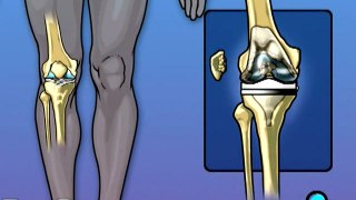 Knee Replacement Surgery  - Alternatives
