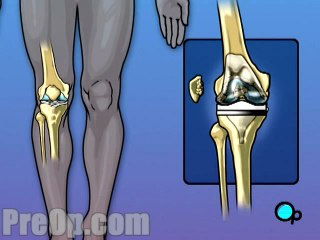 Knee Replacement Surgery  - Alternatives
