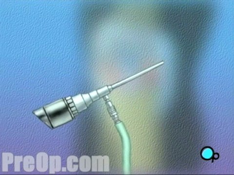 Anterior Cruciate Ligament Arthroscopic Repair Surgery - Alternatives