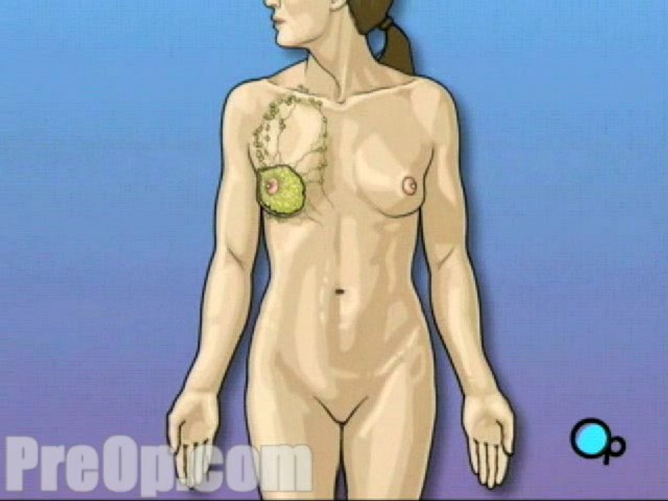 Mastectomy Total Surgery  - Alternatives