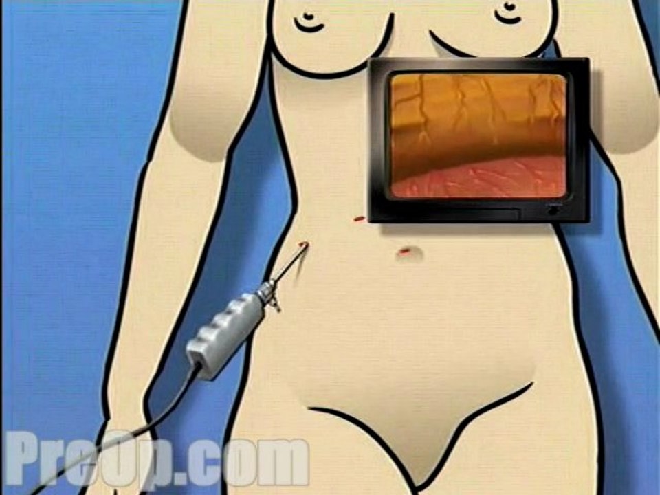 Gastric Adjustable Band Laparoscopic Surgery  - Alternatives