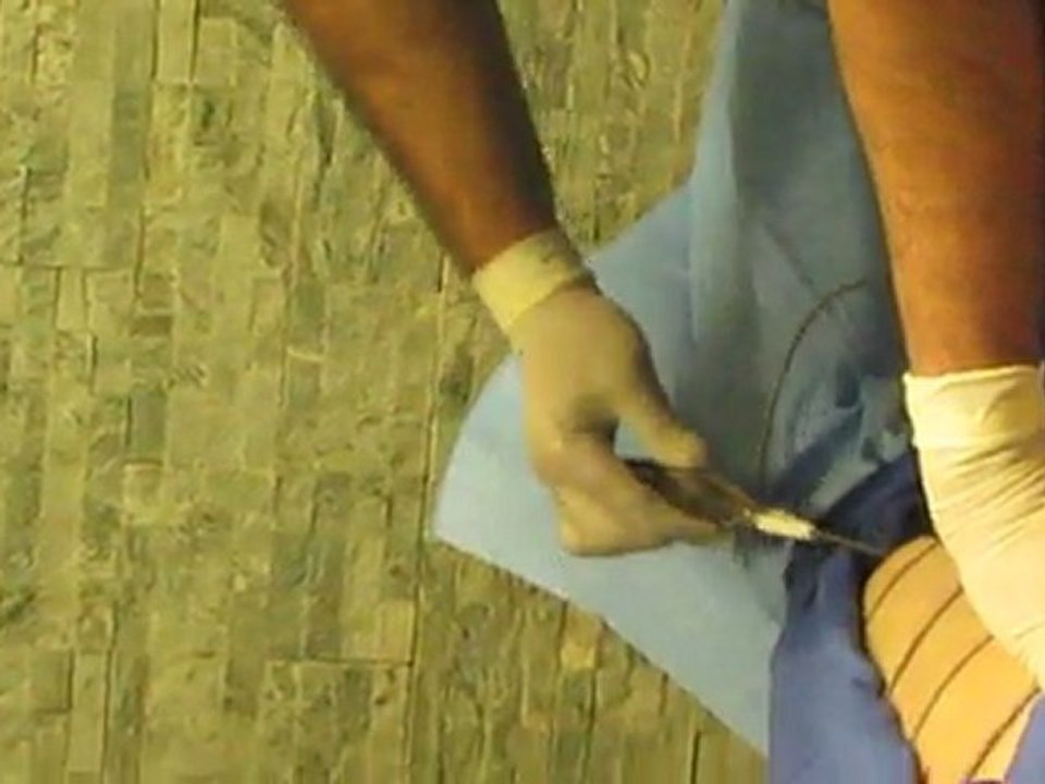 Laser Liposuction-Los Angeles County-Orange County-Riverside County-San Bernardino County-Inland Empire-Anaheim-Fullerton-Rancho Cucamonga-Irvine-Orange-Cerritos-Whittier-Covina-Hacienda Heights-Rowland Heights