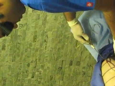 Laser Liposuction-Los Angeles County-Orange County-Riverside County-San Bernardino County-Inland Empire-Anaheim-Fullerton-Rancho Cucamonga-Irvine-Orange-Cerritos-Whittier-Covina-Hacienda Heights-Rowland Heights