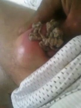 Percer un gros bouton plein de pus