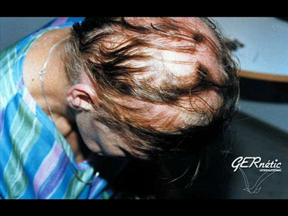 Eigenhaartransplantation