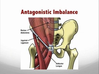Understanding Athletic Pubalgia & Pelvic Imbalances in Athletes