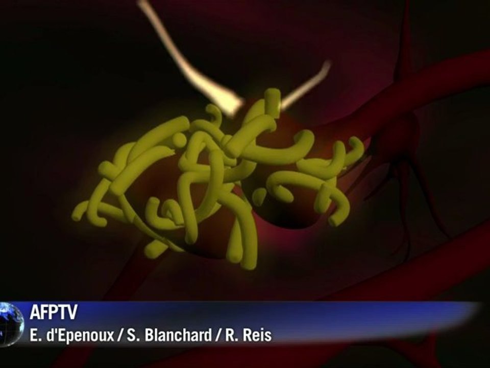Videografik: Alzheimer - das schleichende Vergessen