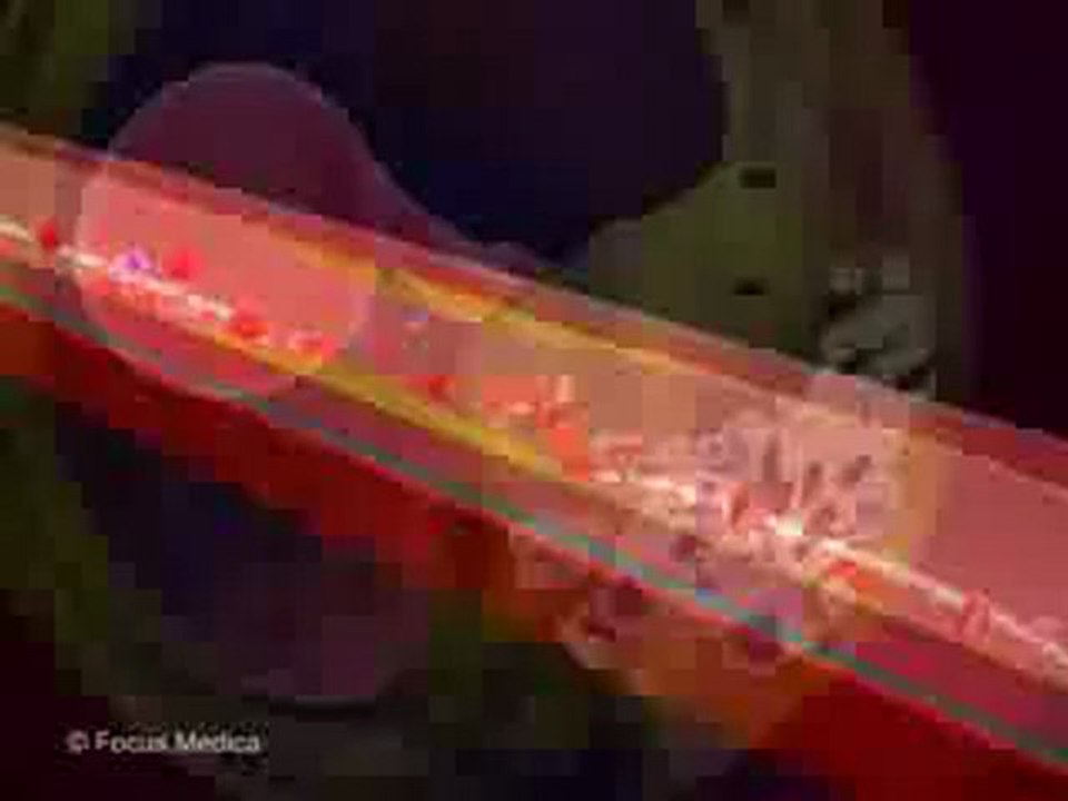 Coronary Artery Disease (Animated Pocket Dictionary_ Cardiology)