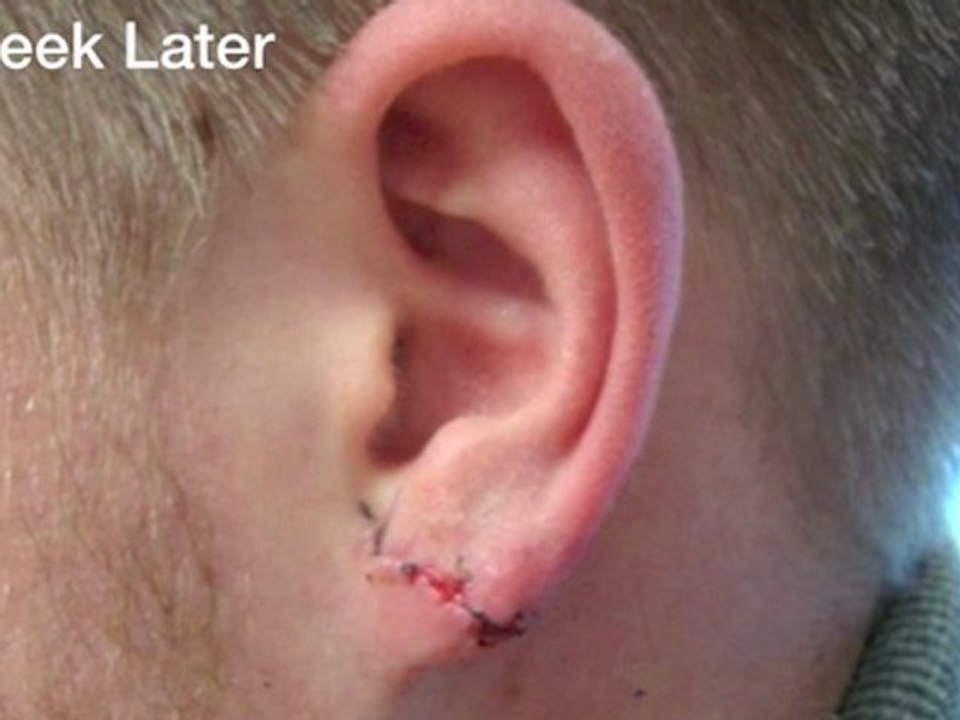 Stretched earlobe Correction Testimonial Photos