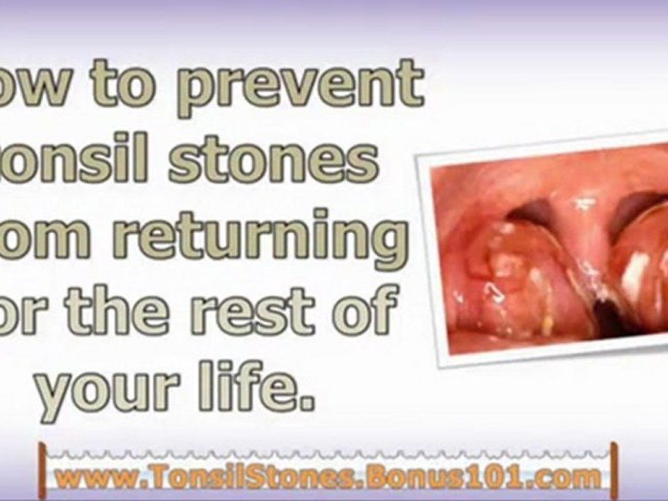 how to prevent tonsil stones - getting rid of tonsil stones - tonsil stones remedy
