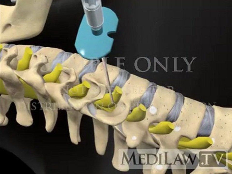 Cervical Spine Selective Nerve Root Block neuro-surgical animations