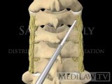 Cervical Spine Posterior Surgery Lateral Mass Screw Fusion Fixation witness opinion 3D animations