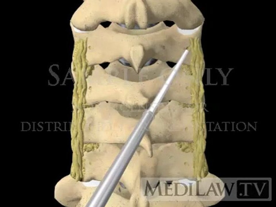 Cervical Spine Posterior Surgery Lateral Mass Screw Fusion Fixation witness opinion 3D animations