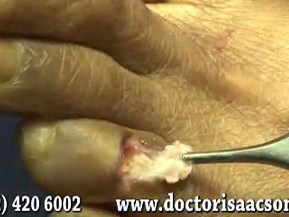 NYC Hammertoe Surgery - Manhattan Podiatrist