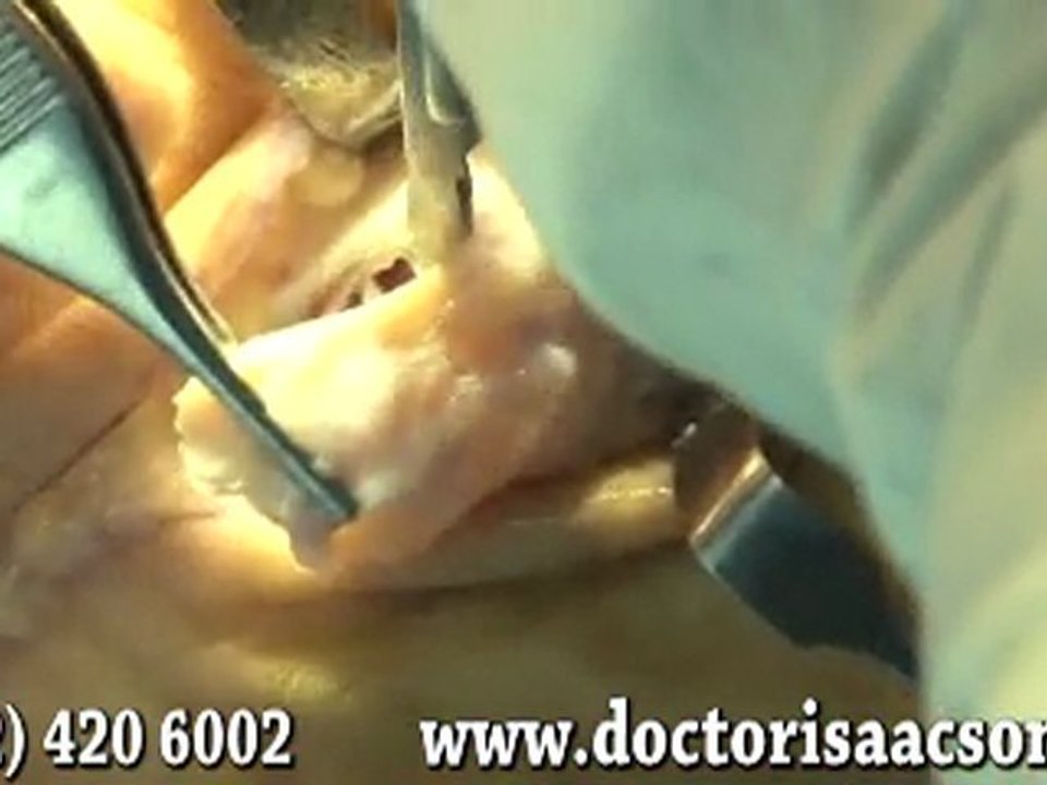 NYC Plantar Fibroma Surgery - Manhattan Podiatrist