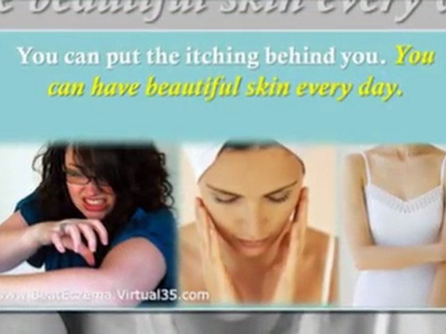 hand eczema treatment – eczema home treatment – eczema treatment