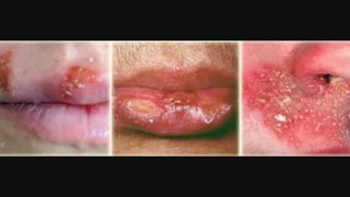 How To Relieve Cold Sores -Tips To Treat Cold Sore - How To Cure Cold Sore Fast