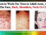 home acne remedies - aloe vera acne - acne juvenil