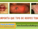 Tratamiento natural del herpes - Como curar el Herpes