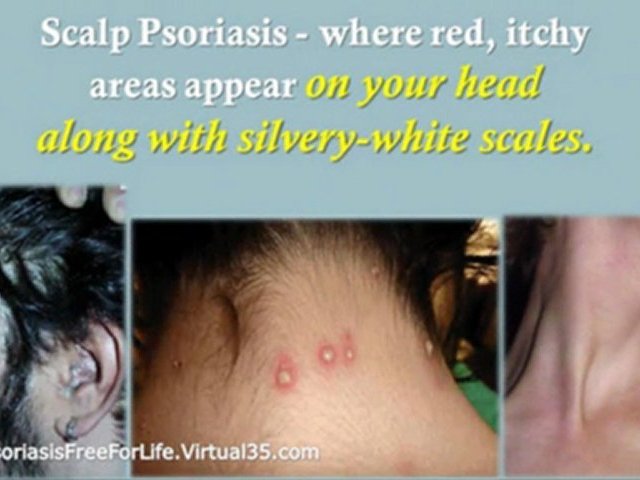 natural psoriasis treatment – treatment of psoriasis