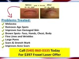 Laser Skin Rejuvenation Sterling Va|$397 Cosmetic Laser