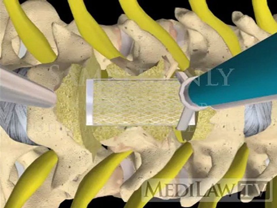 Cervical Spine Surgery Vertebrectomy Corpectomy with cage + plate decompression fixation fusion neurosurgical animations